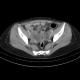 Endometriosis, ovarian endometriosis: CT - Computed tomography